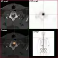 Natriumfluorid PET-CT desselben Patienten: Die osteolytische Knochenmetastase im Halswirbelsäule zeigt einen extremen Uptake und ist klar erkennbar Die beiden weiteren Knochenmetastasen in der Lendenwirbelsäule stellen sich in der PET ebenfalls sehr gut dar.