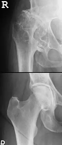 Im oberen Röntgenbild eines menschlichen Hüftgelenkes erkennt man die deutlichen Veränderungen durch eine Hüftgelenksarthrose bei Hüftdysplasie. Es finden sich im Randbereich des Gelenkes mehrere Osteophyten. Im unteren Bild ist zum Vergleich das Röntgenbild eines gesunden Hüftgelenkes abgebildet.