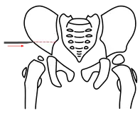 Salter-Osteotomie rechts. Schritt 1 – Osteotomie des Os ilium