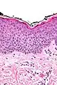 Spongiose: Gefügelockerung der Epidermis mit sichtbaren Spalten zwischen den einzelnen Zellen durch interzelluläres Ödem