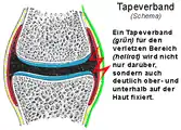 Positionierung des Tapeverbandes (grün).Knorpel (blau), Kapsel (rot), Band (gelb) Knochen (grau).