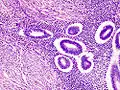 Adenomyosis uteri im mikroskopischen Bild