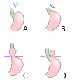 Hiato-herniaren eraketa