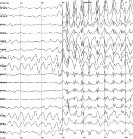 Graph showing 16 voltage traces going across the page from left to right, each showing a different signal. At the middle of the page all of the traces abruptly begin to show sharp jerky spikes, which continue to the end of the plot.